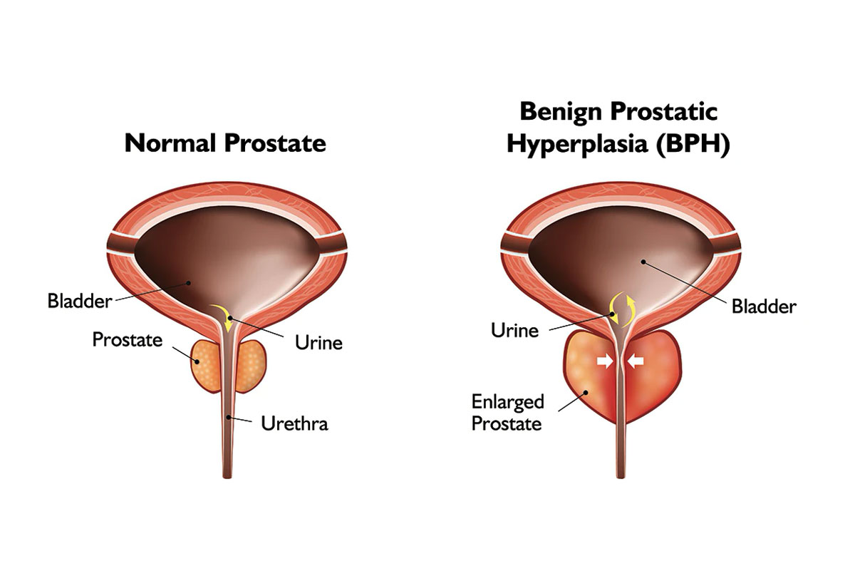 normal prostate vs prostate with BPH